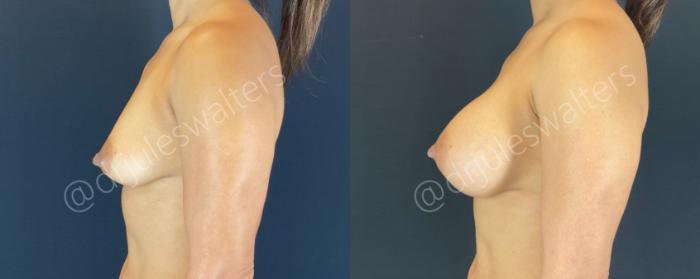 Before & After Breast Augmentation Case 144 Left Side View in Metairie and New Orleans, LA