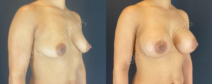 Before & After Breast Augmentation Case 144 Right Oblique View in Metairie and New Orleans, LA