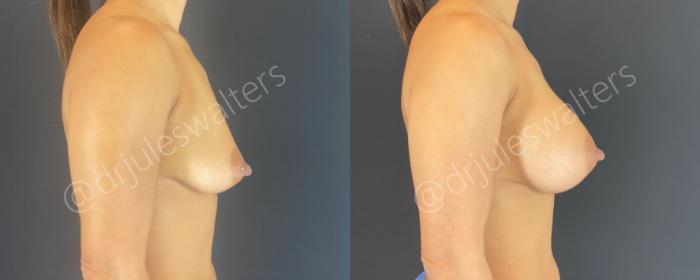 Before & After Breast Augmentation Case 144 Right Side View in Metairie and New Orleans, LA