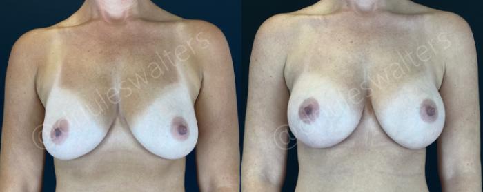 Before & After Breast Augmentation Case 153 Front View in Metairie and New Orleans, LA