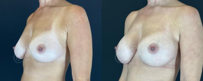 Before & After Breast Augmentation Case 153 Left Oblique View in Metairie and New Orleans, LA