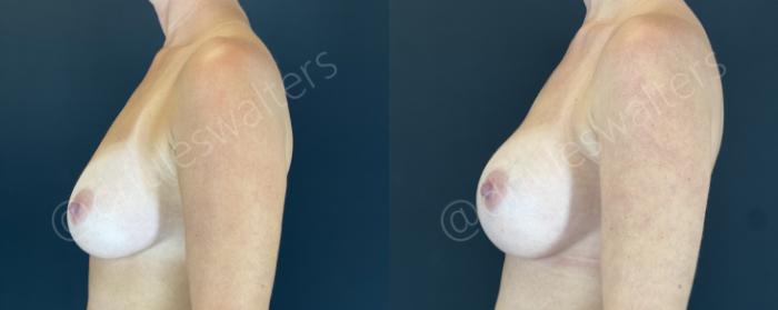 Before & After Breast Augmentation Case 153 Left Side View in Metairie and New Orleans, LA