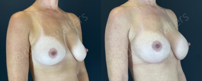 Before & After Breast Augmentation Case 153 Right Oblique View in Metairie and New Orleans, LA
