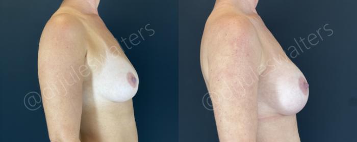Before & After Breast Augmentation Case 153 Right Side View in Metairie and New Orleans, LA