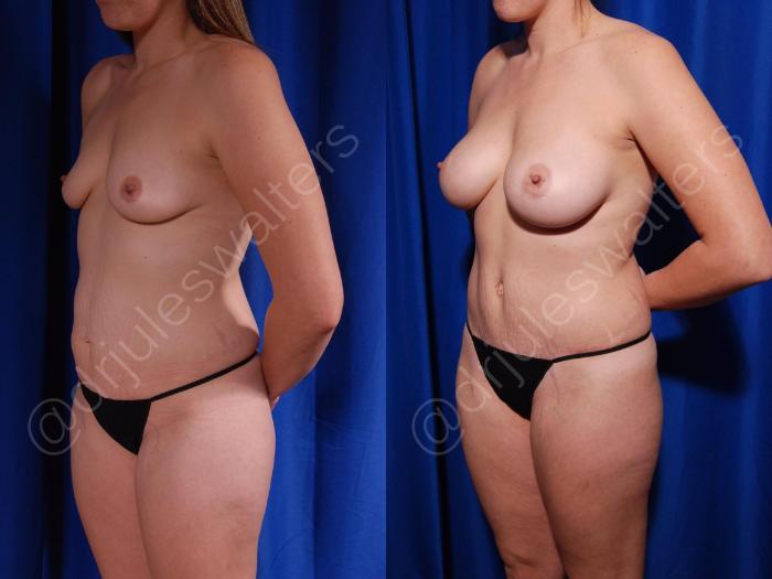Before & After Liposuction Case 154 Left Oblique View in Metairie and New Orleans, LA