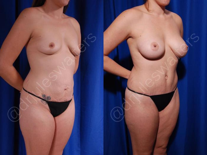 Before & After Liposuction Case 154 Right Oblique View in Metairie and New Orleans, LA