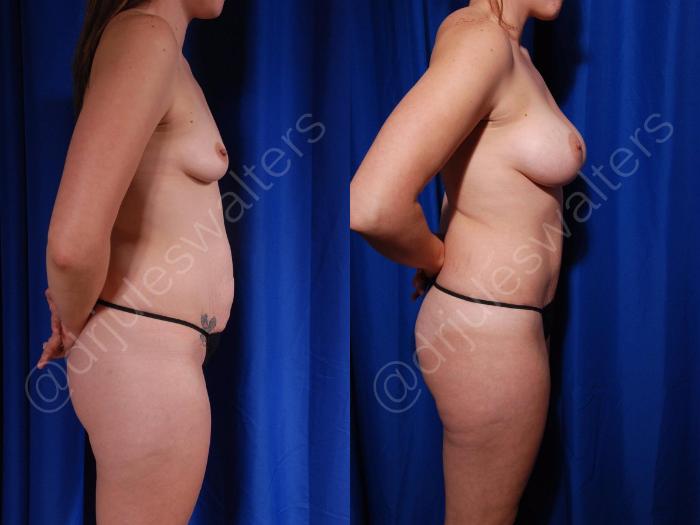 Before & After Liposuction Case 154 Right Side View in Metairie and New Orleans, LA