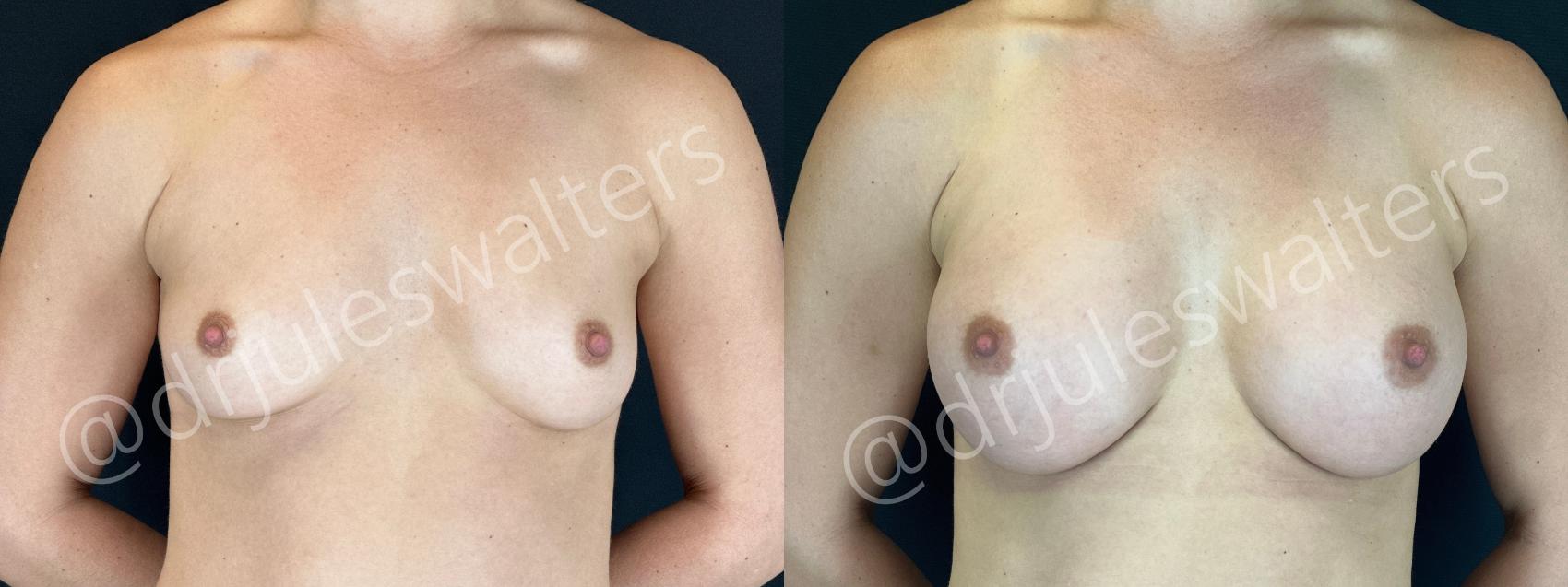Before & After Breast Augmentation Case 155 Front View in Metairie and New Orleans, LA