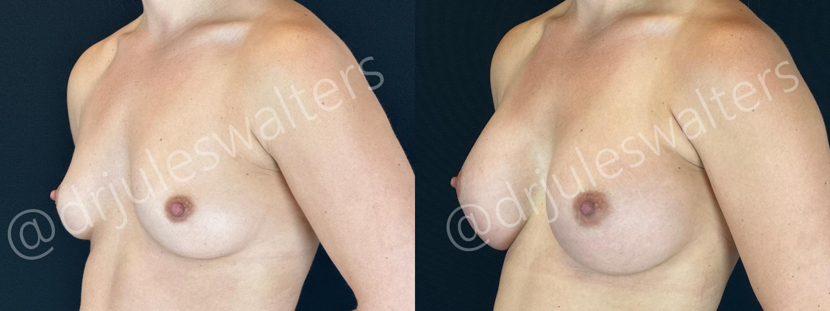 Before & After Breast Augmentation Case 155 Left Oblique View in Metairie and New Orleans, LA