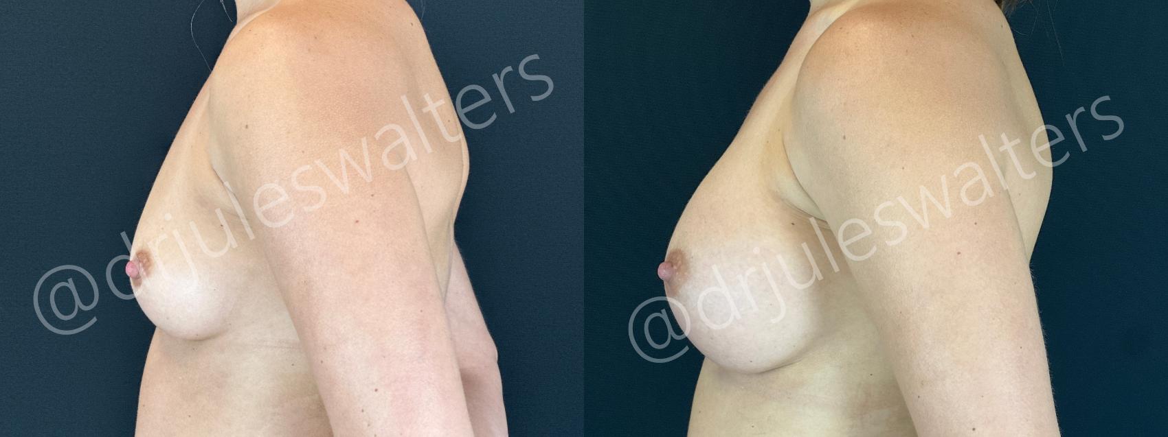 Before & After Breast Augmentation Case 155 Left Side View in Metairie and New Orleans, LA