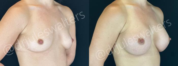 Before & After Breast Augmentation Case 155 Right Oblique View in Metairie and New Orleans, LA