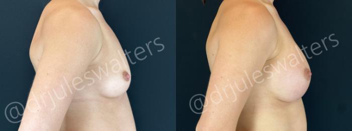 Before & After Breast Augmentation Case 155 Right Side View in Metairie and New Orleans, LA