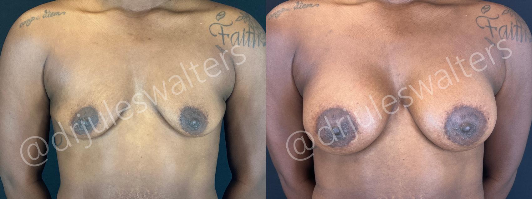 Before & After Breast Augmentation Case 156 Front View in Metairie and New Orleans, LA