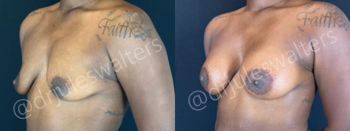Before & After Breast Augmentation Case 156 Left Oblique View in Metairie and New Orleans, LA