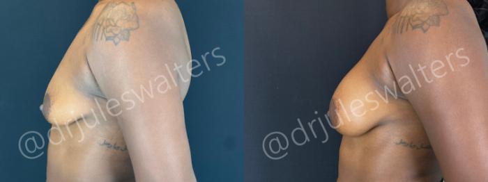 Before & After Breast Augmentation Case 156 Left Side View in Metairie and New Orleans, LA