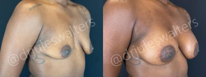 Before & After Breast Augmentation Case 156 Right Oblique View in Metairie and New Orleans, LA