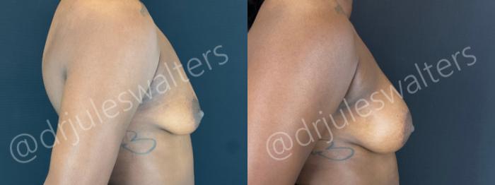 Before & After Breast Augmentation Case 156 Right Side View in Metairie and New Orleans, LA