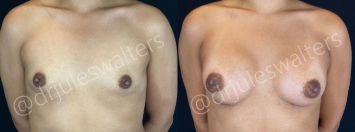 Before & After Breast Augmentation Case 159 Front View in Metairie and New Orleans, LA