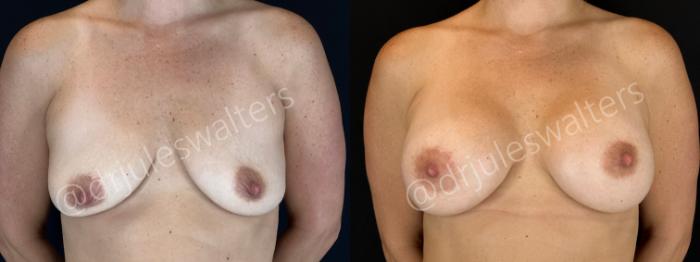 Before & After Breast Augmentation Case 161 Front View in Metairie and New Orleans, LA