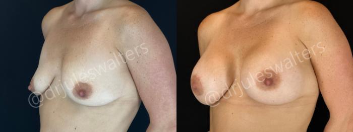 Before & After Breast Augmentation Case 161 Left Oblique View in Metairie and New Orleans, LA