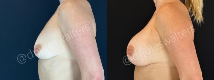 Before & After Breast Augmentation Case 161 Left Side View in Metairie and New Orleans, LA