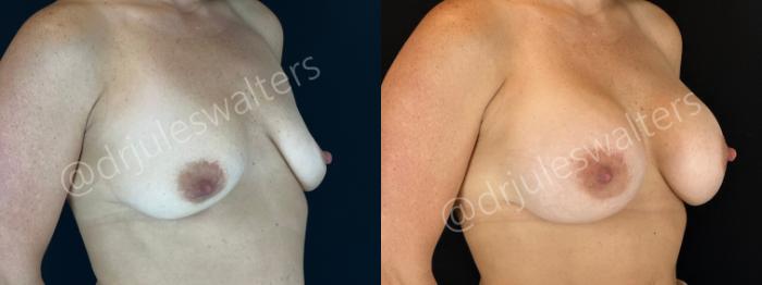 Before & After Breast Augmentation Case 161 Right Oblique View in Metairie and New Orleans, LA