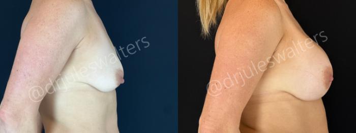 Before & After Breast Augmentation Case 161 Right Side View in Metairie and New Orleans, LA
