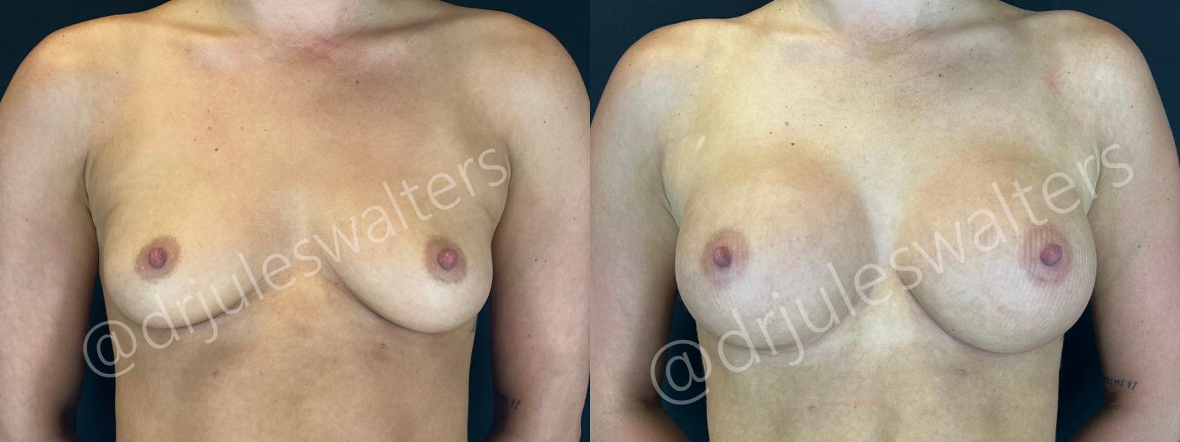 Before & After Breast Augmentation Case 162 Front View in Metairie and New Orleans, LA