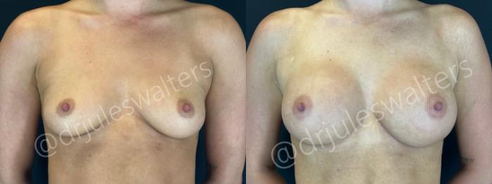 Before & After Breast Augmentation Case 162 Front View in Metairie and New Orleans, LA