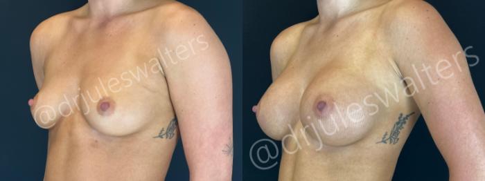 Before & After Breast Augmentation Case 162 Left Oblique View in Metairie and New Orleans, LA