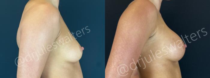 Before & After Breast Augmentation Case 162 Right Side View in Metairie and New Orleans, LA