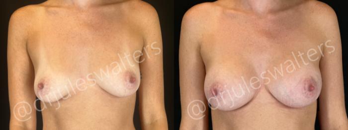 Before & After Breast Augmentation Case 163 Front View in Metairie and New Orleans, LA