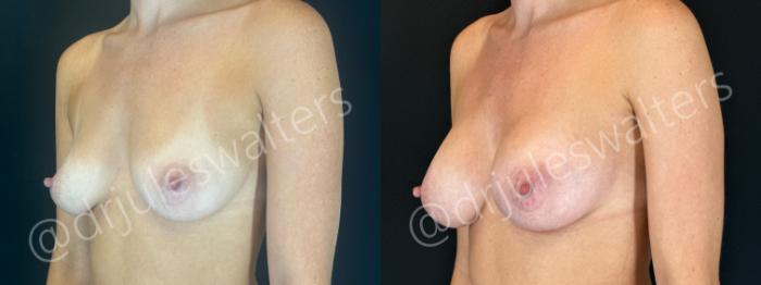 Before & After Breast Augmentation Case 163 Left Oblique View in Metairie and New Orleans, LA
