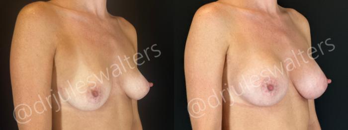 Before & After Breast Augmentation Case 163 Right Oblique View in Metairie and New Orleans, LA