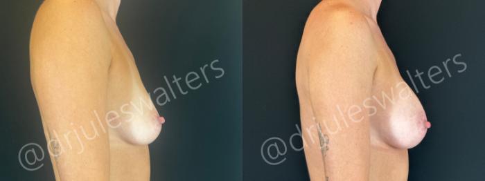 Before & After Breast Augmentation Case 163 Right Side View in Metairie and New Orleans, LA