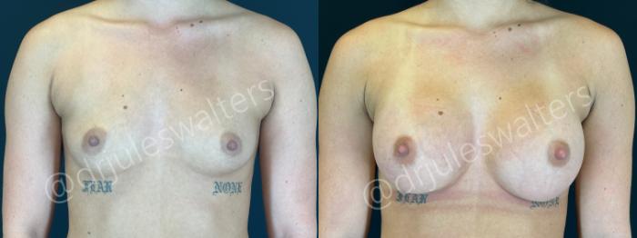 Before & After Breast Augmentation Case 164 Front View in Metairie and New Orleans, LA