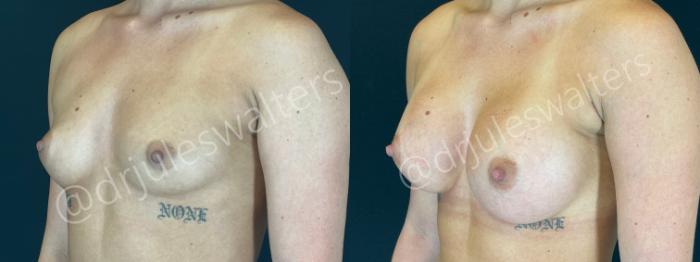 Before & After Breast Augmentation Case 164 Left Oblique View in Metairie and New Orleans, LA