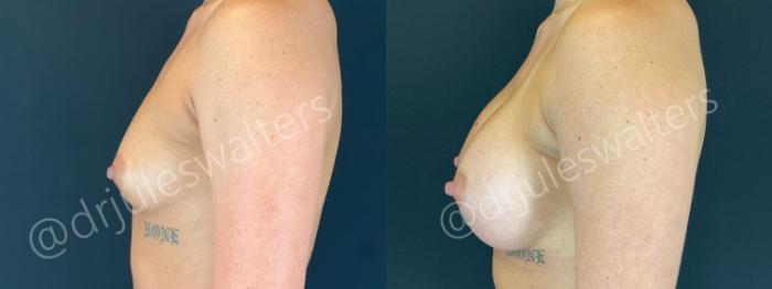 Before & After Breast Augmentation Case 164 Left Side View in Metairie and New Orleans, LA