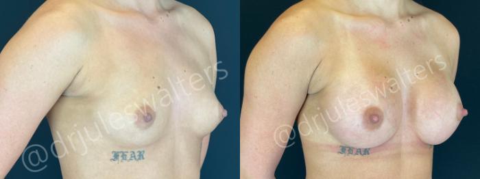 Before & After Breast Augmentation Case 164 Right Oblique View in Metairie and New Orleans, LA