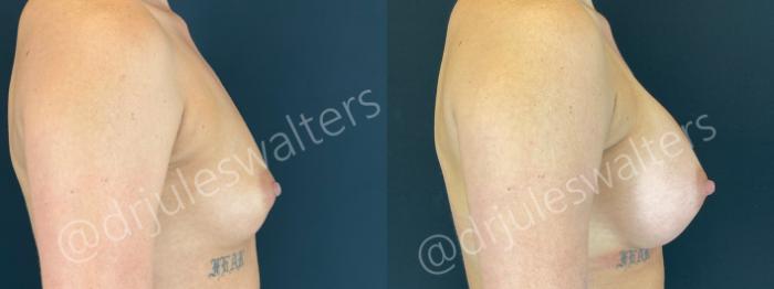 Before & After Breast Augmentation Case 164 Right Side View in Metairie and New Orleans, LA