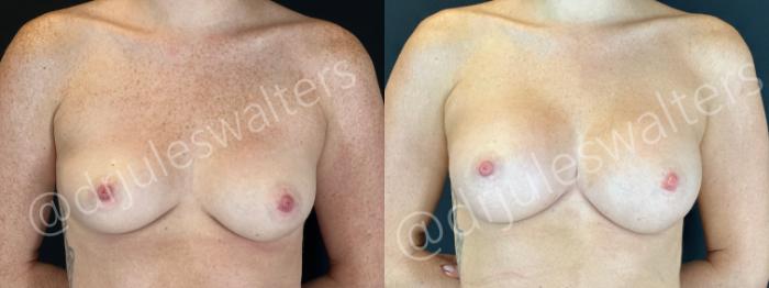 Before & After Breast Augmentation Case 169 Front View in Metairie and New Orleans, LA