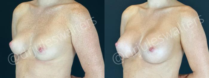 Before & After Breast Augmentation Case 169 Left Oblique View in Metairie and New Orleans, LA