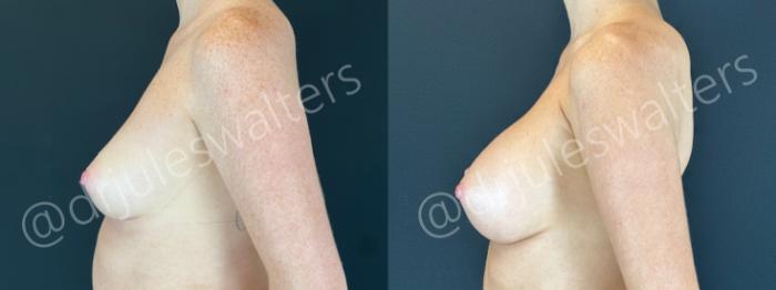 Before & After Breast Augmentation Case 169 Left Side View in Metairie and New Orleans, LA