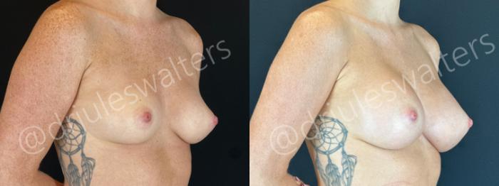 Before & After Breast Augmentation Case 169 Right Oblique View in Metairie and New Orleans, LA