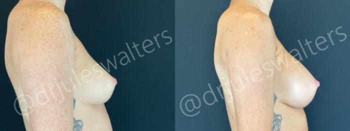 Before & After Breast Augmentation Case 169 Right Side View in Metairie and New Orleans, LA