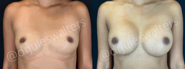 Before & After Breast Augmentation Case 170 Front View in Metairie and New Orleans, LA