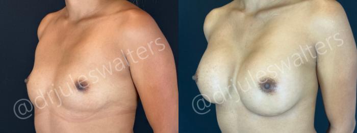 Before & After Breast Augmentation Case 170 Left Oblique View in Metairie and New Orleans, LA