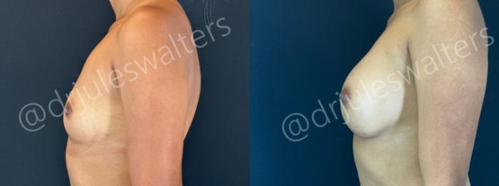 Before & After Breast Augmentation Case 170 Left Side View in Metairie and New Orleans, LA