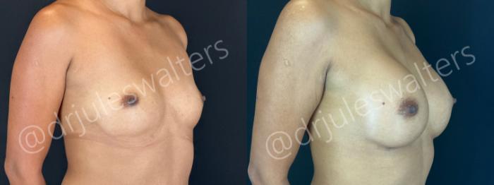 Before & After Breast Augmentation Case 170 Right Oblique View in Metairie and New Orleans, LA