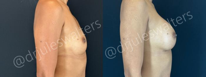 Before & After Breast Augmentation Case 170 Right Side View in Metairie and New Orleans, LA
